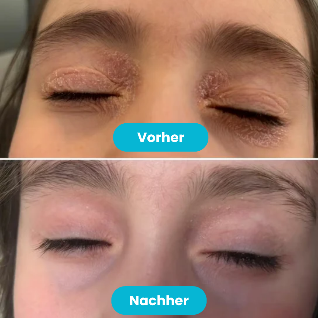 Beralen™ – Repair Balsam bei Ekzem & Schuppenflechte