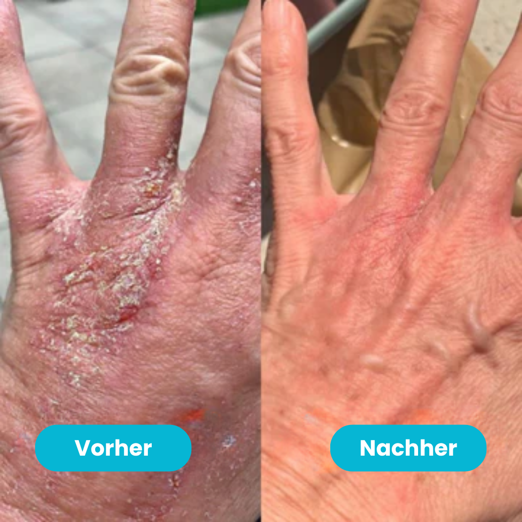 Beralen™ – Repair Balsam bei Ekzem & Schuppenflechte