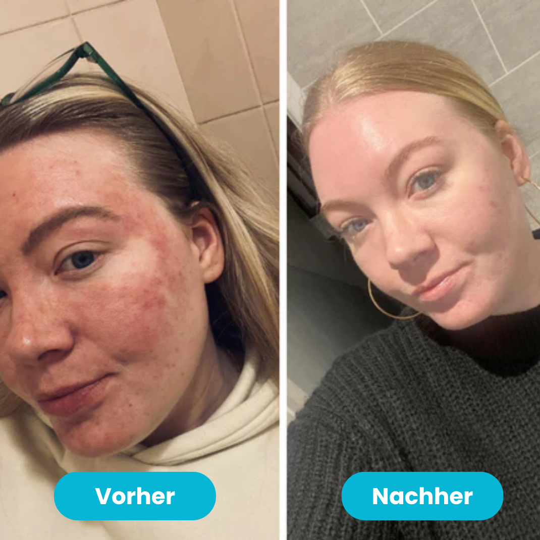 Beralen™ – Repair Balsam bei Ekzem & Schuppenflechte