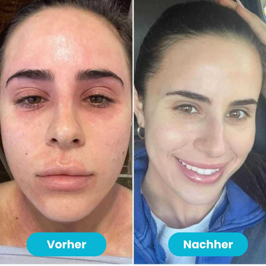 Beralen™ – Repair Balsam bei Ekzem & Schuppenflechte